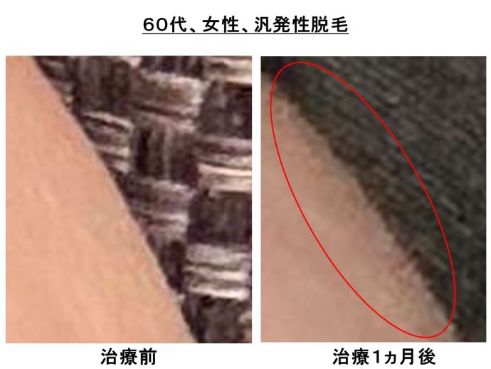 円形脱毛症　病院